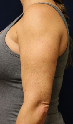 Arm Lift*/Arm Sculpting: Case 2 - After Left