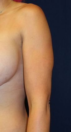 Arm Lift*/Arm Sculpting: Case 4 - After