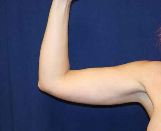 Arm Lift*/Arm Sculpting: Case 4 - After