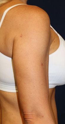Arm Lift*/Arm Sculpting: Case 6 - After Back