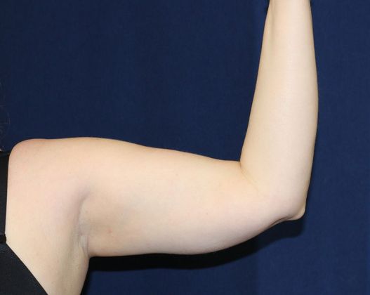 Arm Lift*/Arm Sculpting: Case 5 - Before Front