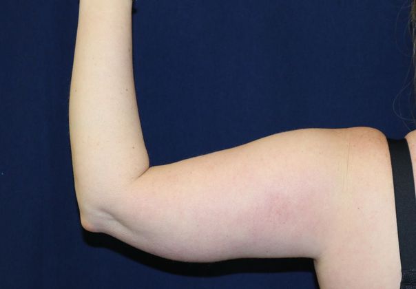 Arm Lift*/Arm Sculpting: Case 5 - Before Back