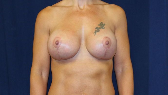 Breast Lift With Augmentation*: Case 25 - After