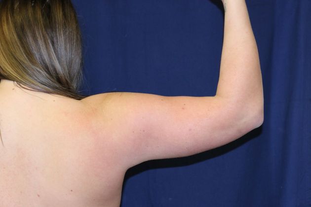 Arm Lift*/Arm Sculpting: Case 9 - After