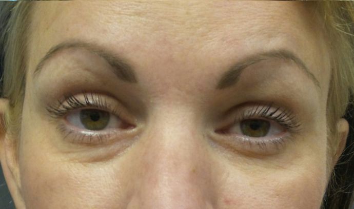 Cosmetic Injectables & Fillers*: Case 33 Undereye Filler - Before