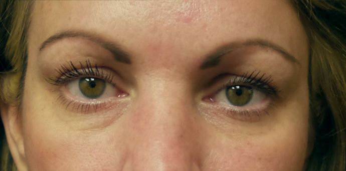 Cosmetic Injectables & Fillers*: Case 33 Undereye Filler - After