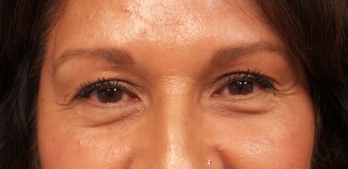 Cosmetic Injectables & Fillers*: Case 31 Undereye Filler - Before