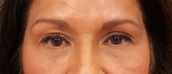 Cosmetic Injectables & Fillers*: Case 31 Undereye Filler - After