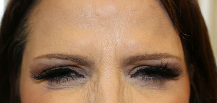 BOTOX® Cosmetic*: Case 6 - After
