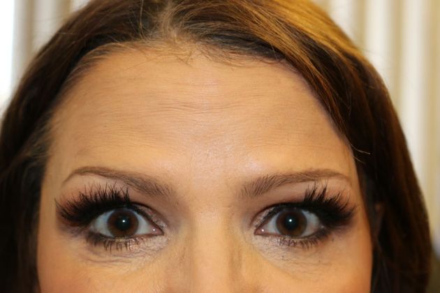 BOTOX® Cosmetic*: Case 6 - After