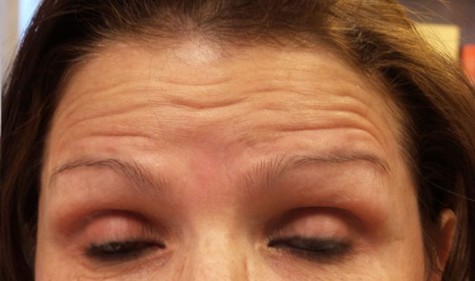 BOTOX® Cosmetic*: Case 6 - Before