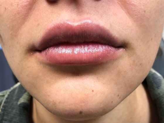 Cosmetic Injectables & Fillers*: Case 18 Lip Filler - After