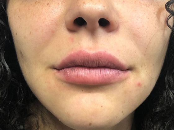 Cosmetic Injectables & Fillers*: Case 18 Lip Filler - Before