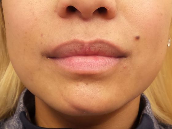 Cosmetic Injectables & Fillers*: Case 15 Lip Filler - Before