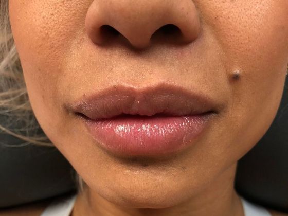 Cosmetic Injectables & Fillers*: Case 15 Lip Filler - After