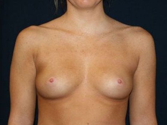 Breast Augmentation*: Case 11 - Front Before