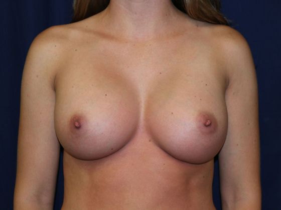 Breast Augmentation*: Case 2 - After
