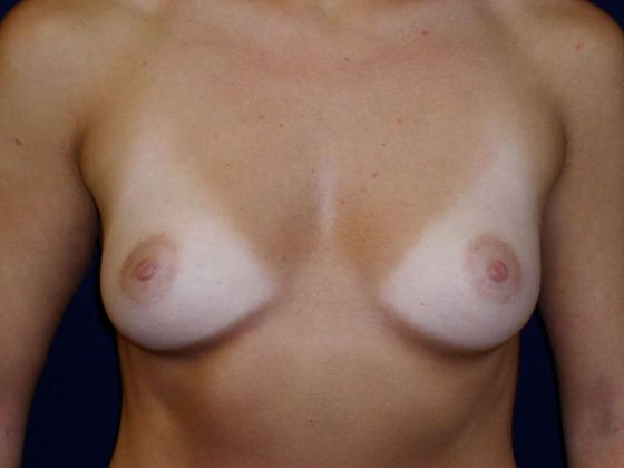 Breast Augmentation*: Case 15 - Front Before