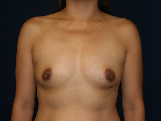 Breast Augmentation*: Case 16 - Front Before