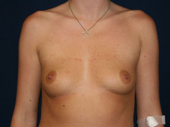 Breast Augmentation*: Case 18 - Front Before