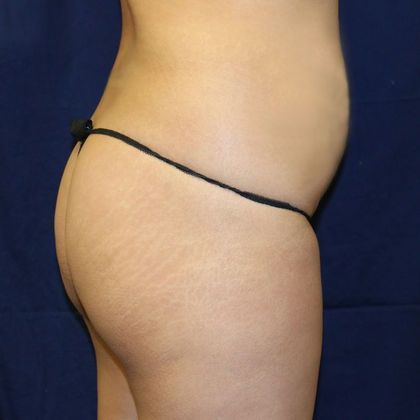 Brazilian Butt Lift : Case 2 - Before