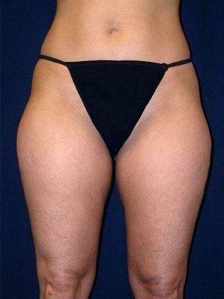 Liposuction & Safe Lipo: Case 1 - Front Before
