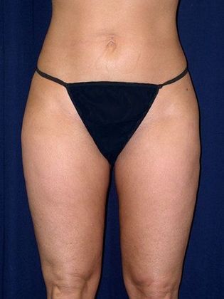 Liposuction & Safe Lipo: Case 1 - Front After