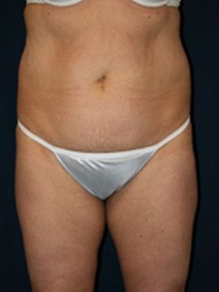 Liposuction & Safe Lipo: Case 2 - Front Before