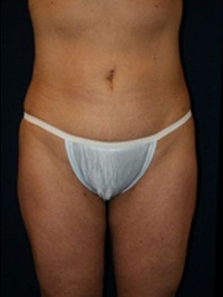 Liposuction & Safe Lipo: Case 2 - Front After
