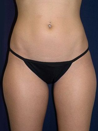 Liposuction & Safe Lipo: Case 3 - Front Before