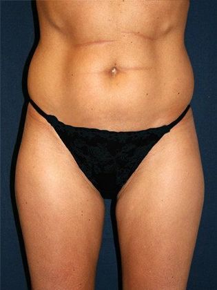 Liposuction & Safe Lipo: Case 5 - Front Before