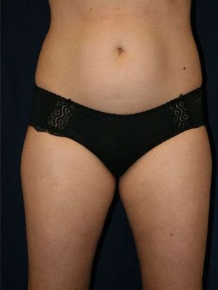 Liposuction & Safe Lipo: Case 7 - Front Before