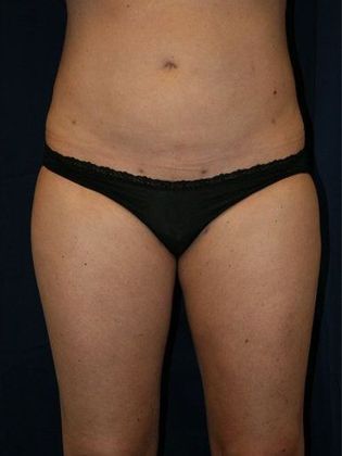 Liposuction & Safe Lipo: Case 7 - Front After
