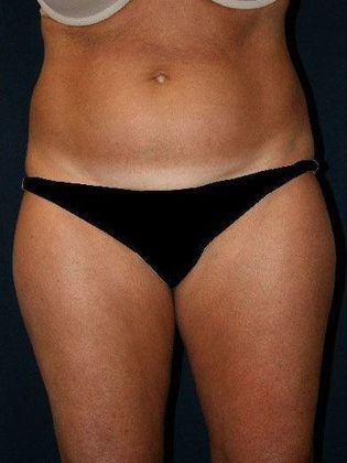 Liposuction & Safe Lipo: Case 9 - Front Before