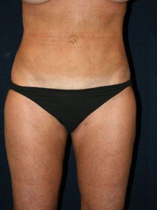 Liposuction & Safe Lipo: Case 9 - Front After