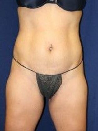 Liposuction & Safe Lipo: Case 10 - Before