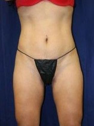 Liposuction & Safe Lipo: Case 10 - After