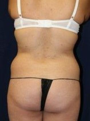 Liposuction & Safe Lipo: Case 11 - Before