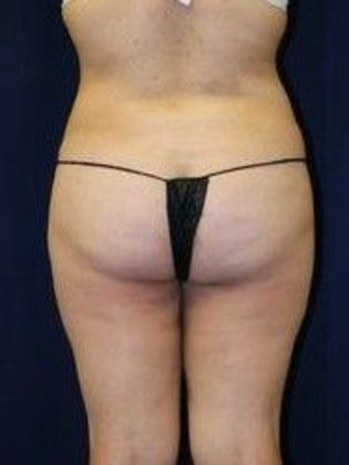 Liposuction & Safe Lipo: Case 11 - After