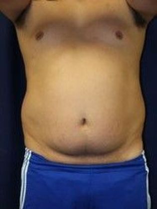 Liposuction & Safe Lipo: Case 13 - After