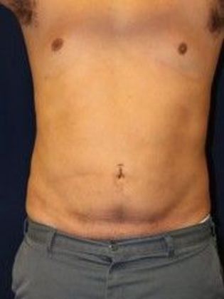 Liposuction & Safe Lipo: Case 13 - Before