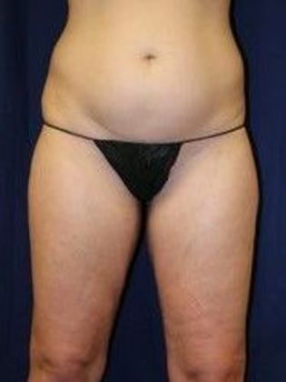 Liposuction & Safe Lipo: Case 14 - Before