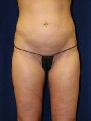 Liposuction & Safe Lipo: Case 14 - After