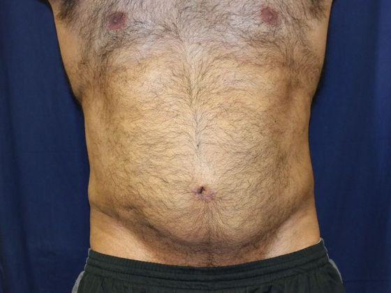 Liposuction & Safe Lipo: Case 18 - After