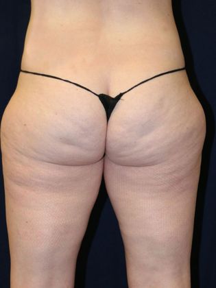Liposuction & Safe Lipo: Case 21 - Before