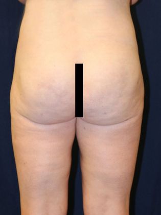Liposuction & Safe Lipo: Case 21 - After
