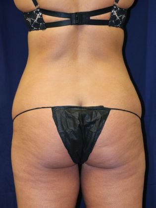 Liposuction & Safe Lipo: Case 22 - Before