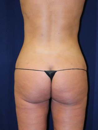 Liposuction & Safe Lipo: Case 22 - After