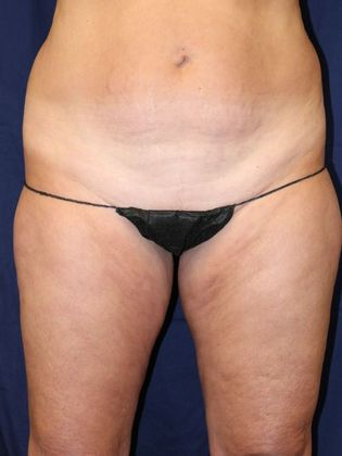 Liposuction & Safe Lipo: Case 23 - Before