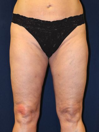 Liposuction & Safe Lipo: Case 23 - After